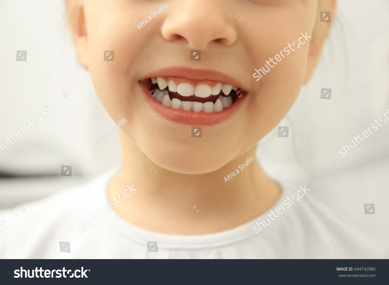 Бутылочный кариес передних зубов
