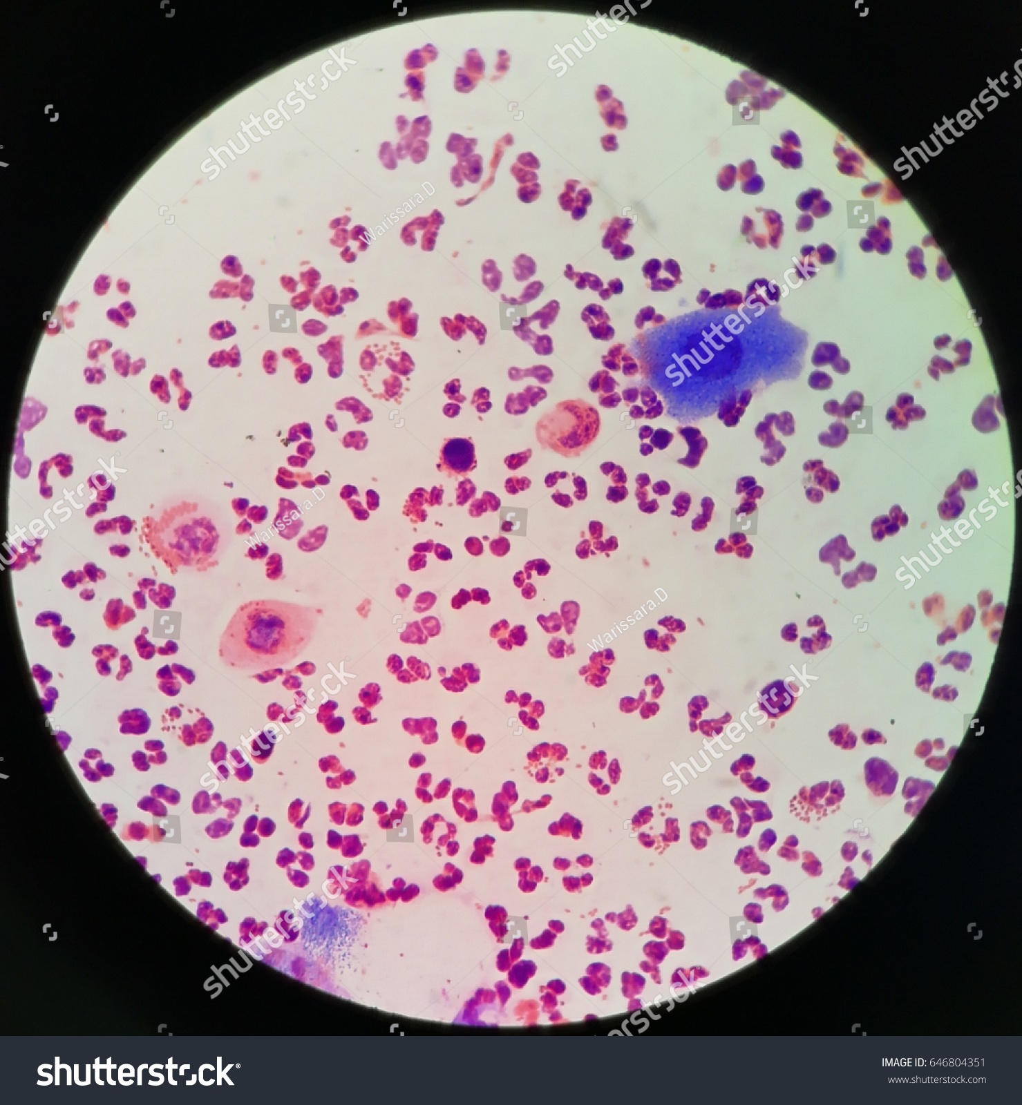Gram Negative Diplococci Neutrophils Stained By Stock Photo 646804351