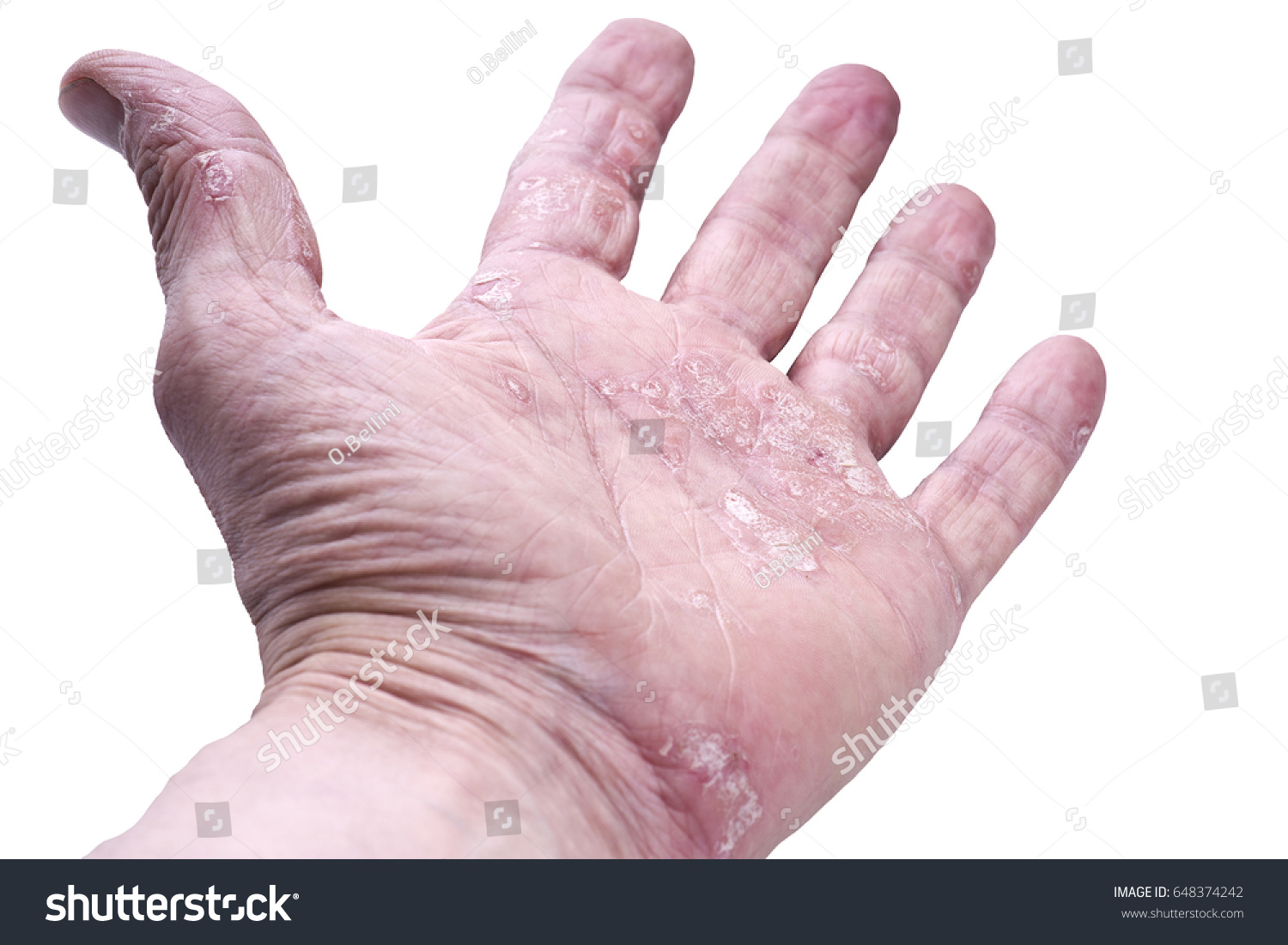 Psoriasis Skin Disease On Joints Body Stock Photo 648374242 | Shutterstock