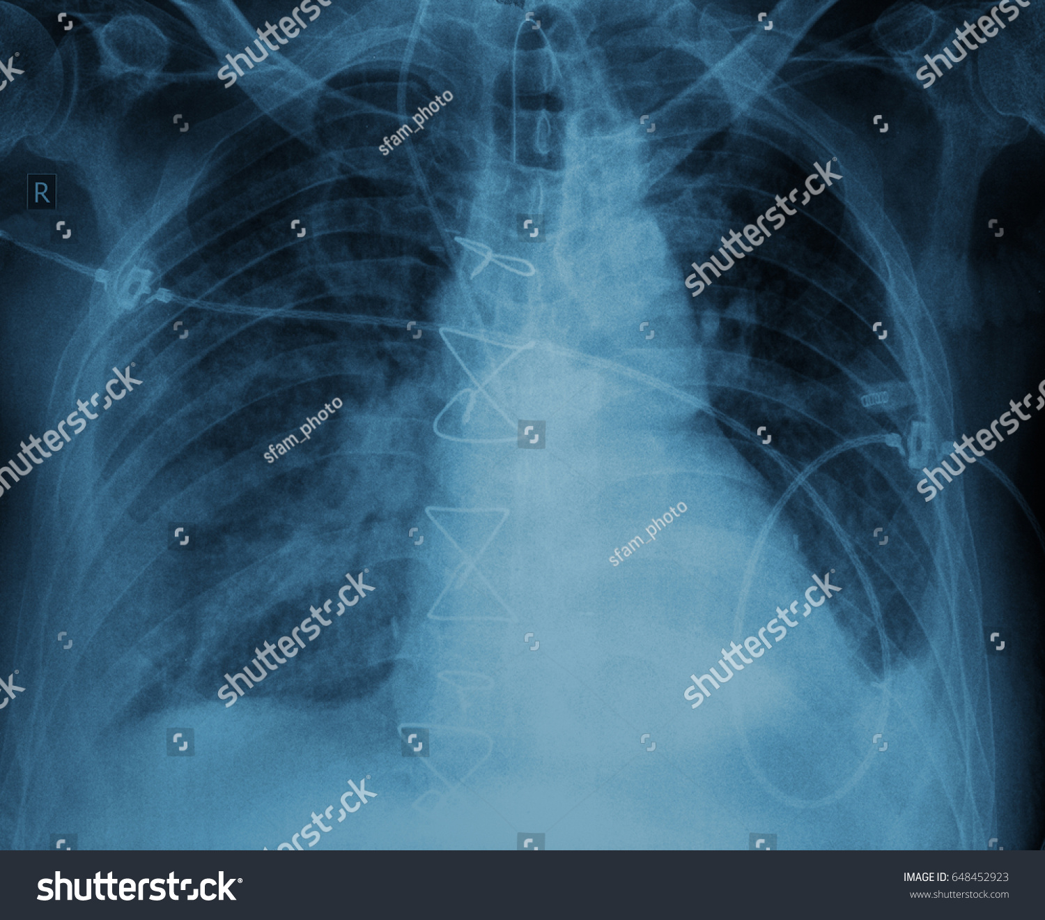 After Surgery Xray Patient Suture Stock Photo 648452923 