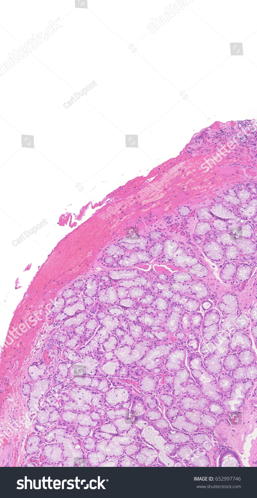 Cancer Screening Biopsy Glandular Structures Clearly Stock Photo ...