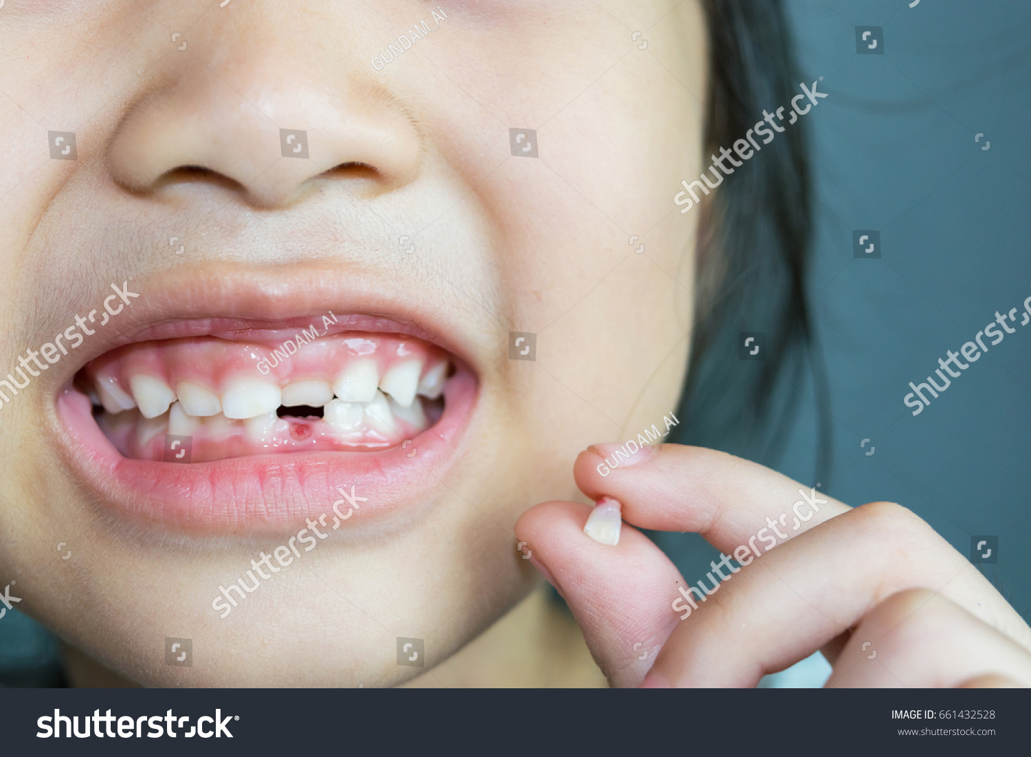 Выпали зубы от кариеса