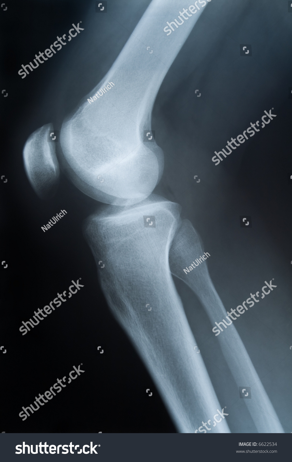 Xray Photograph Single Knee Stock Photo 6622534 | Shutterstock