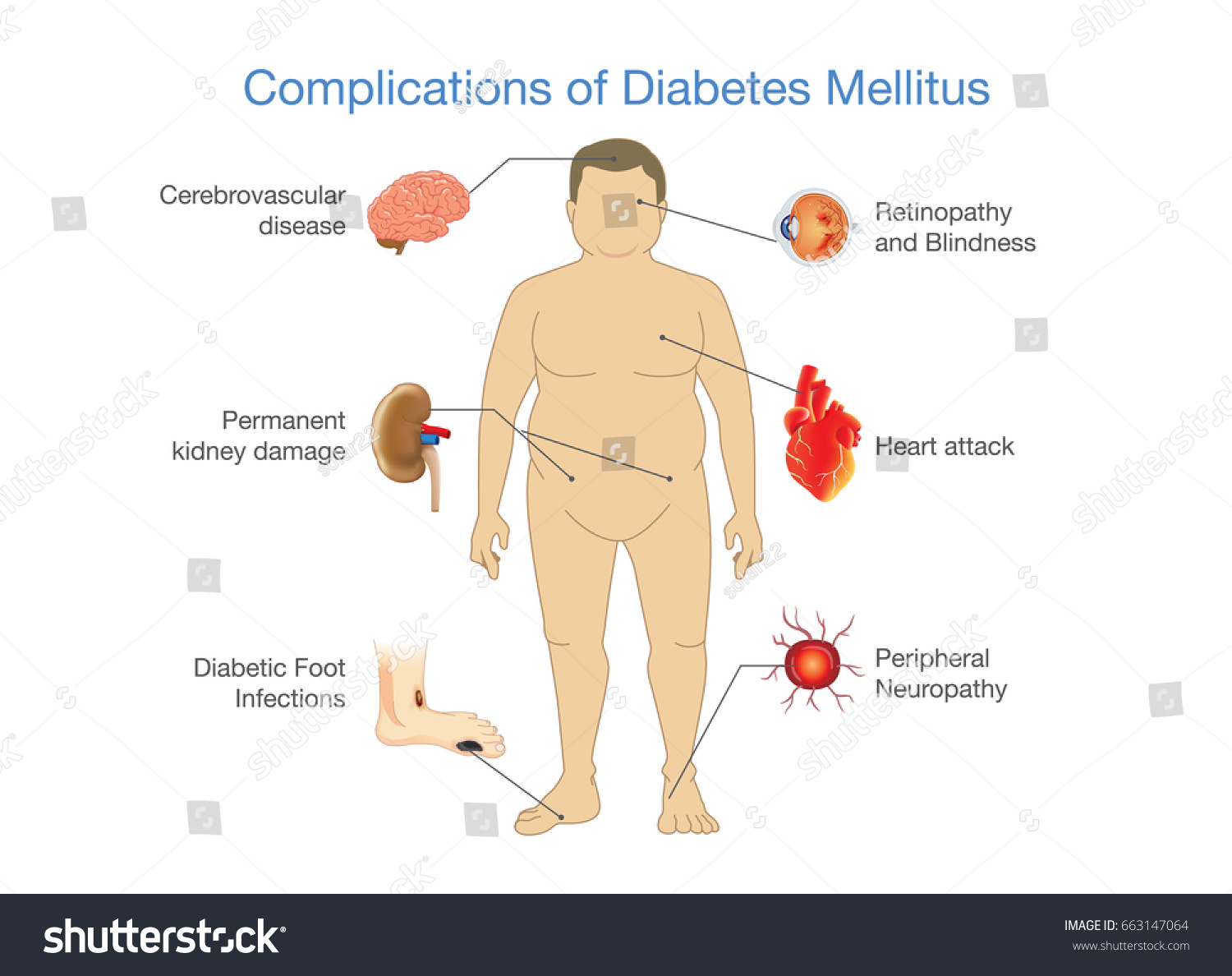 Complications Diabetes Mellitus Fat People Illustration Stock Vector ...