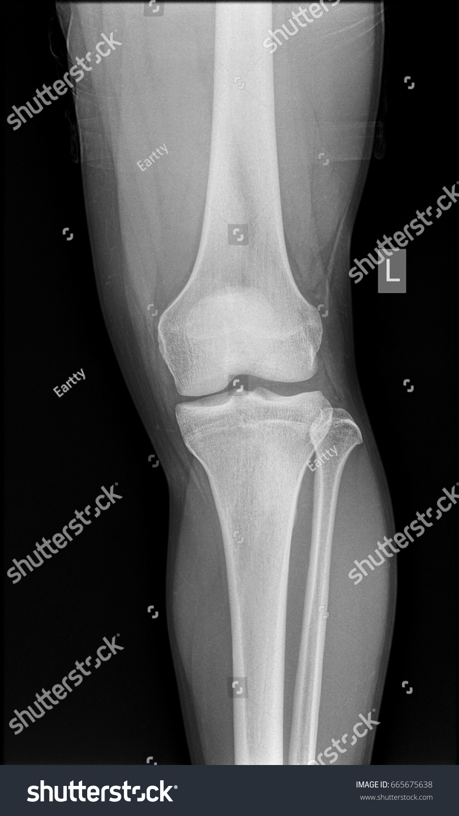 Normal Xrays Human Knee Front View Stock Photo 665675638 | Shutterstock