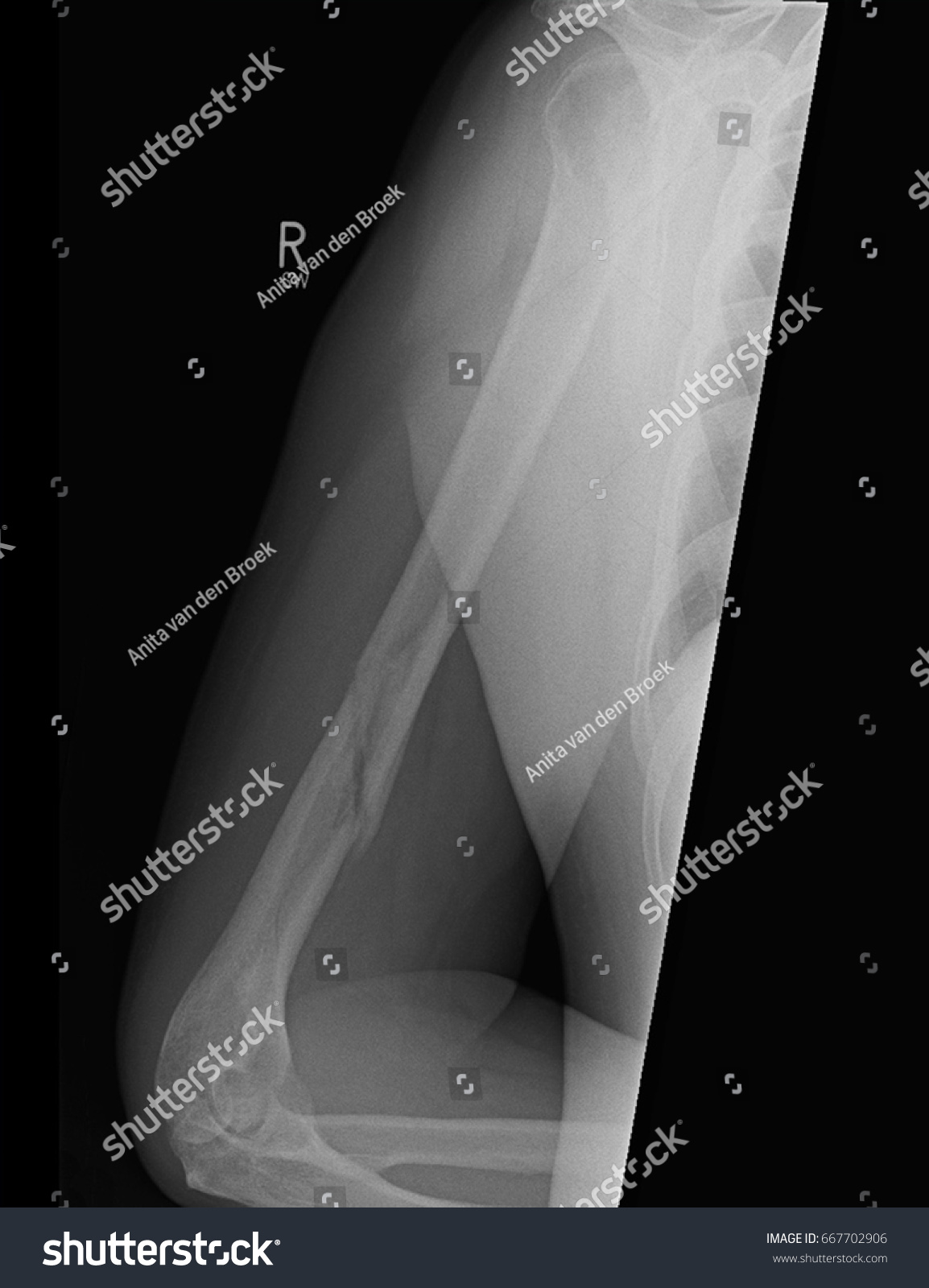 Broken Humerus Xray Showing Compound Spiral Stock Photo 667702906