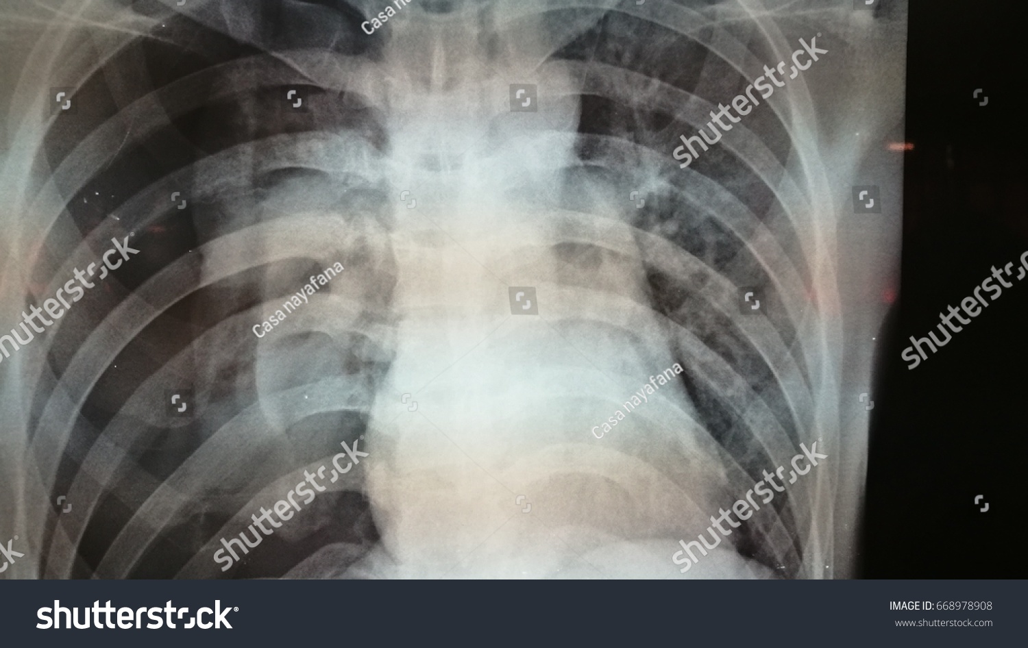 Massive Right Pneumothorax Collapse Lung Secondary Stock Photo ...