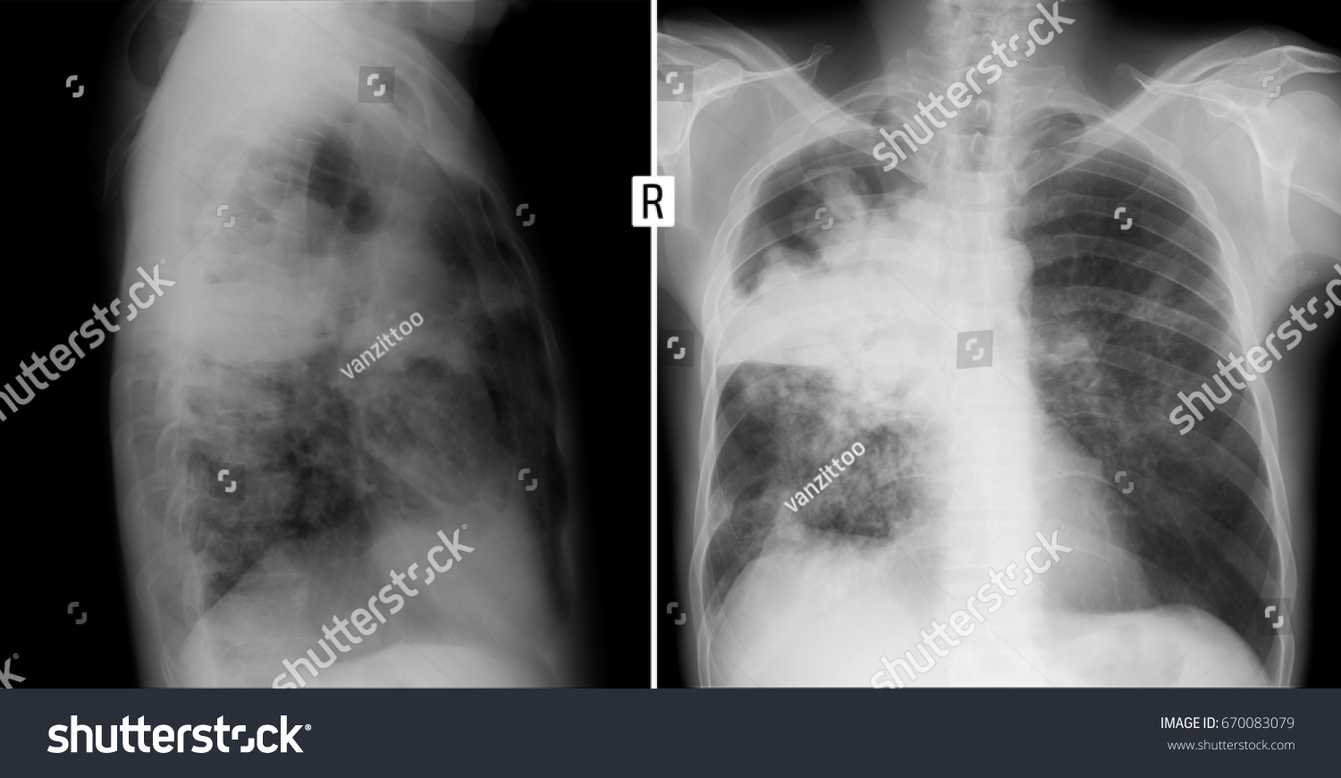 Xray Lungs Cirrhotic Tuberculosis Lungs Stock Photo 670083079 