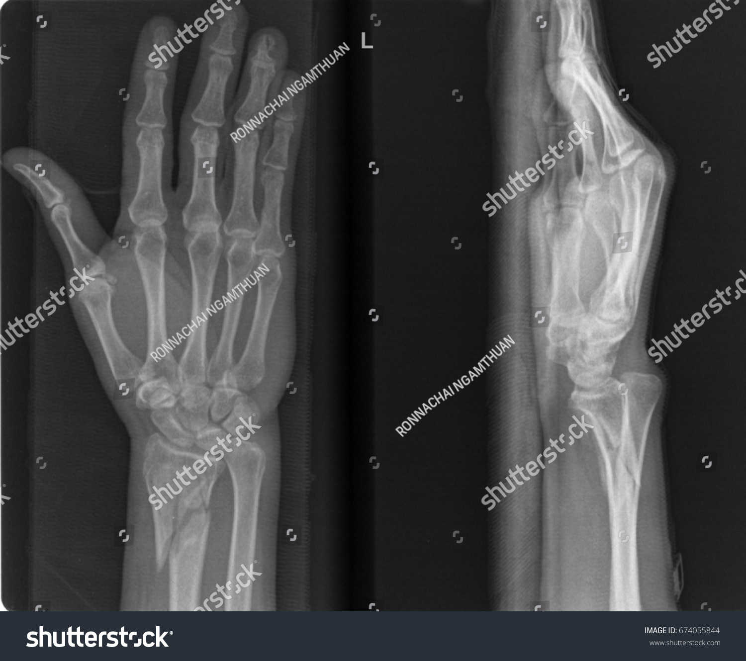 Radiography Hospital Closed Fracture Radius Ulna Stock Photo 674055844 