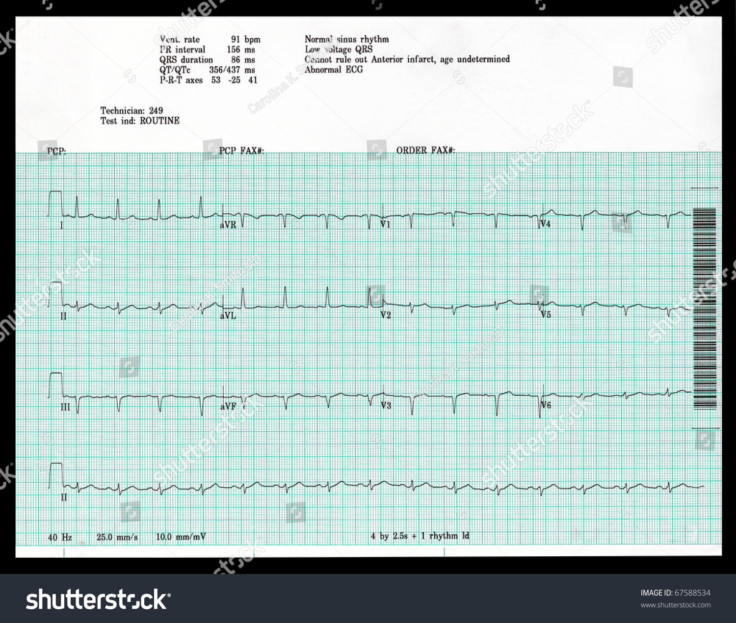 Real Ekg Shows Abnormal Result Stock Photo 67588534 | Shutterstock