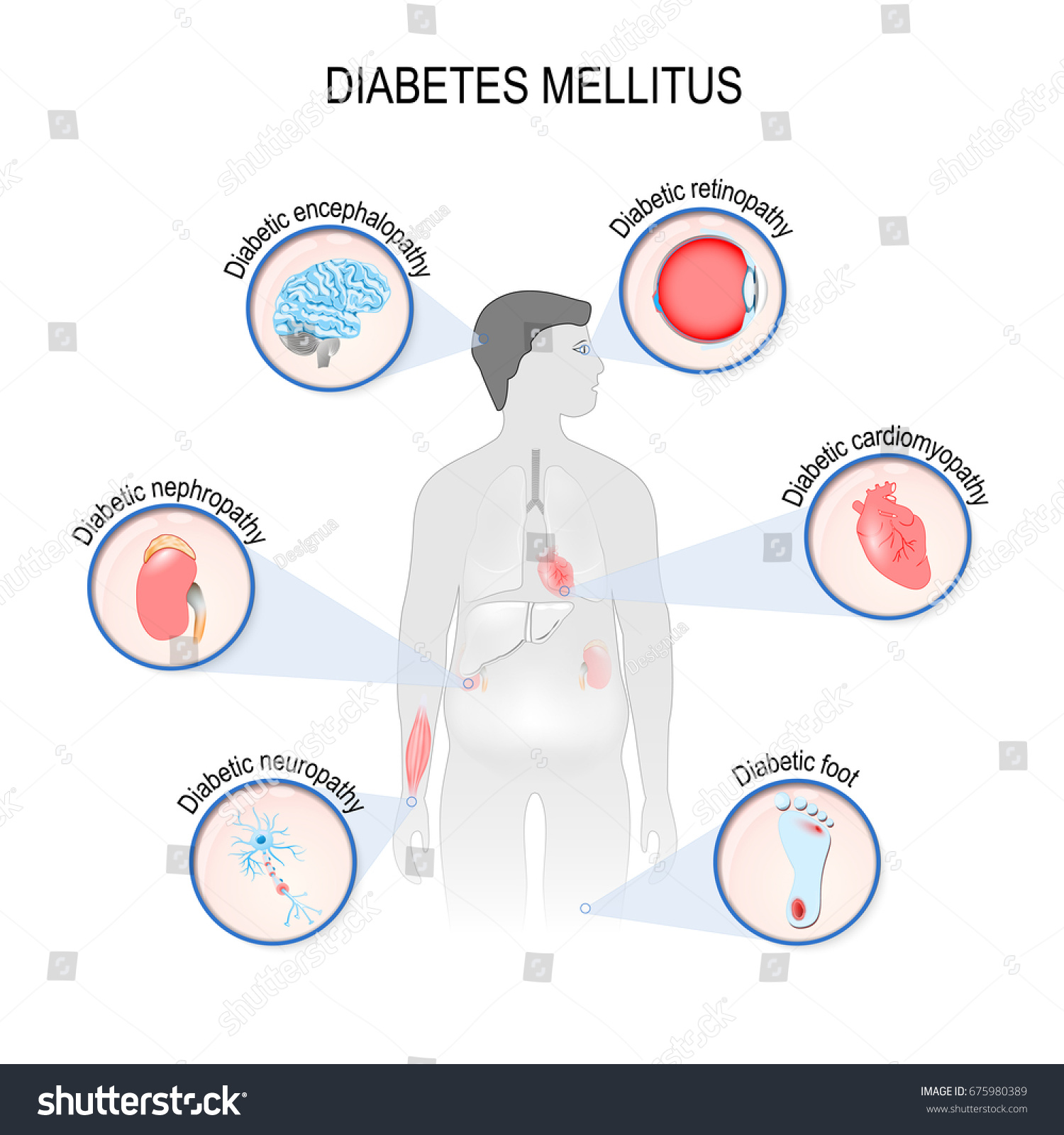 4,776 Diabetes Organs Images, Stock Photos & Vectors | Shutterstock