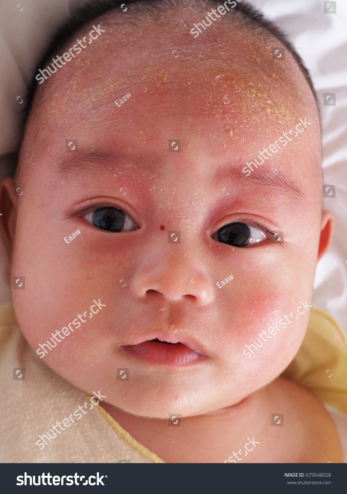 seborrheic dermatitis infant body