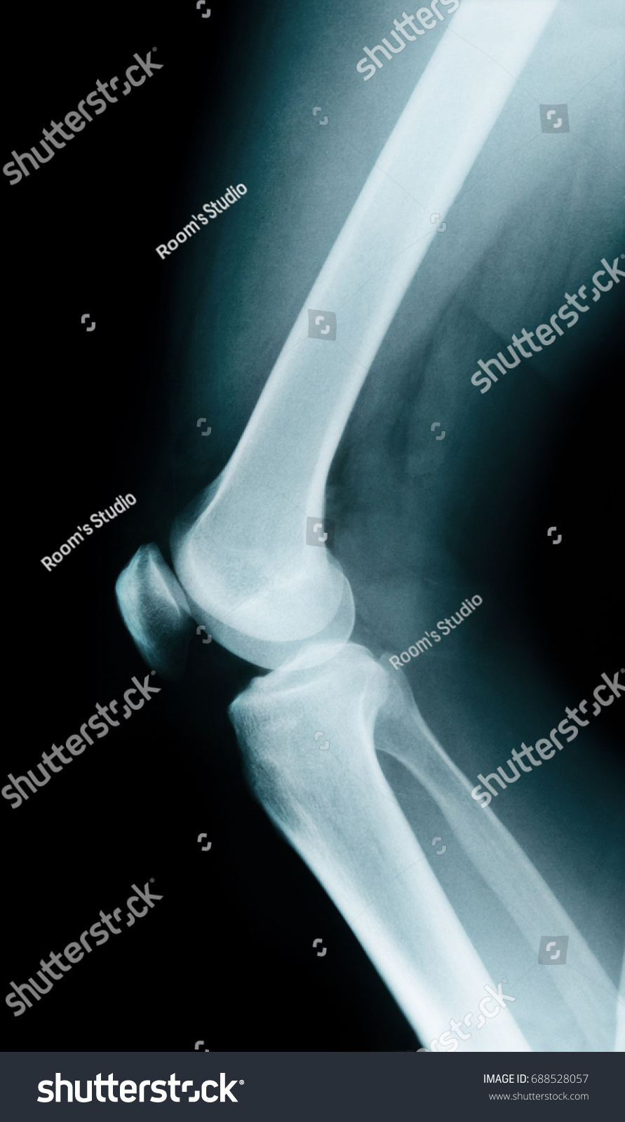 Knee Bone Anatomy X Ray Stock Photo 688528057 | Shutterstock