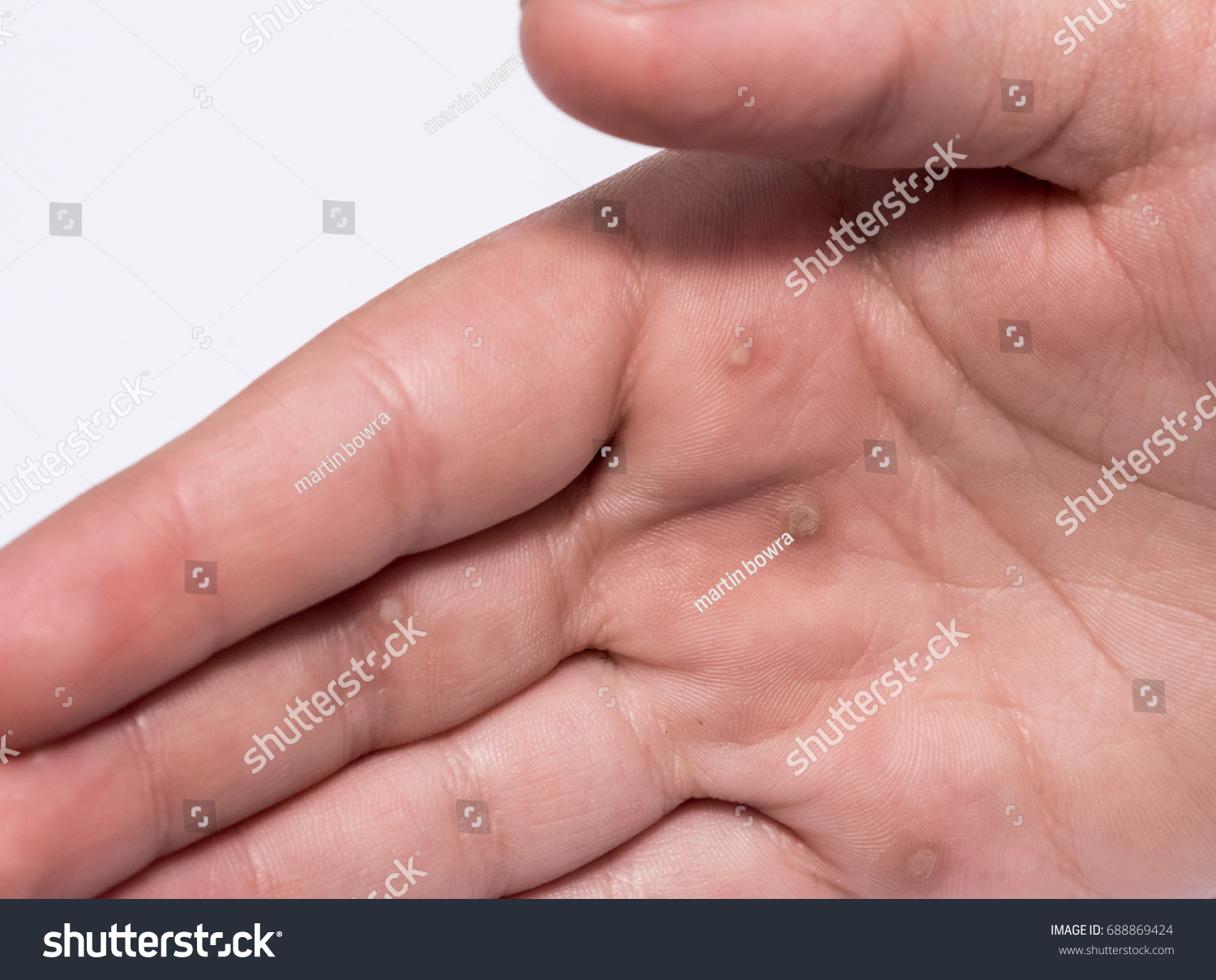 бородавка на пальце у ребенка фото