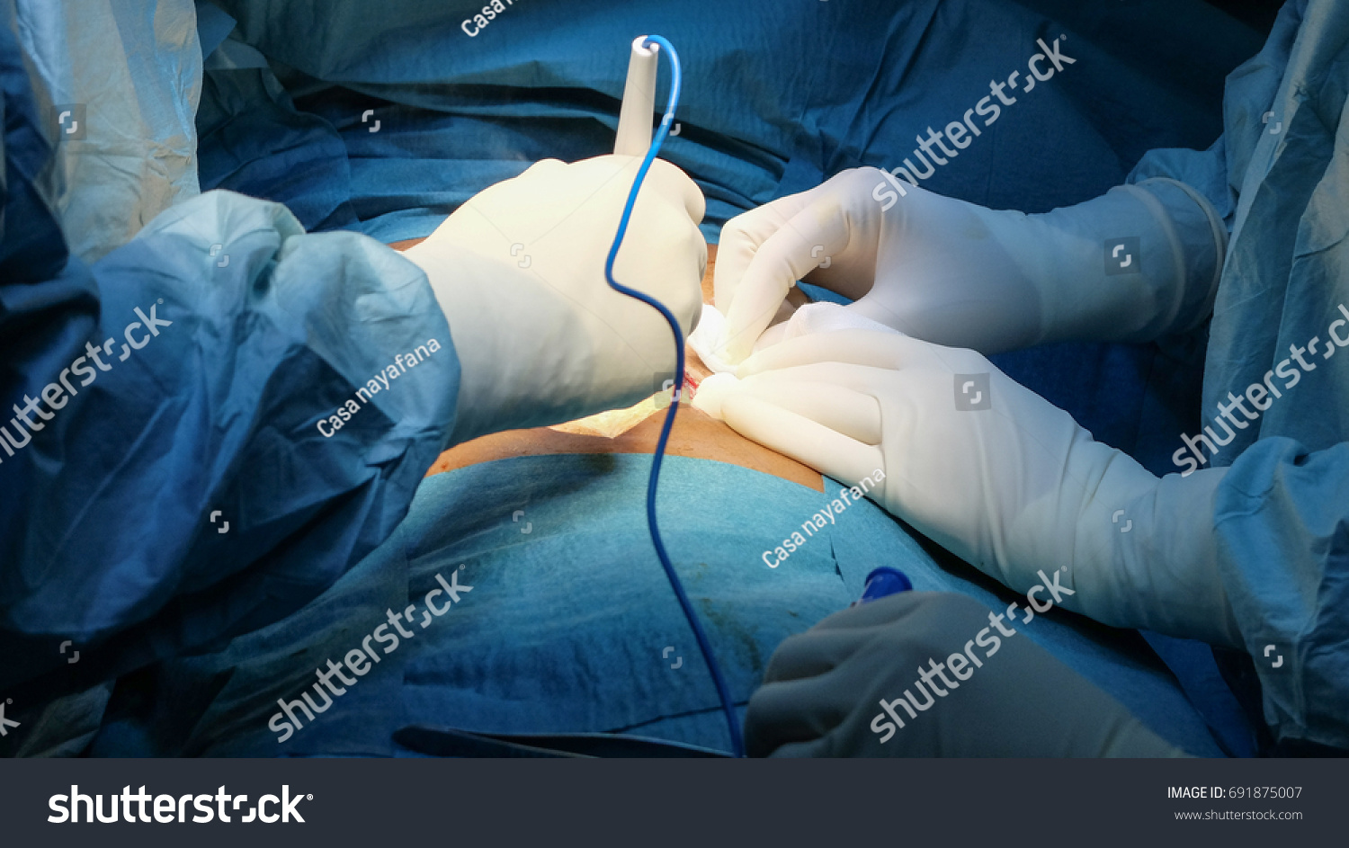 Making Abdominal Skin Incision Diathermy Emergency Stock Photo ...