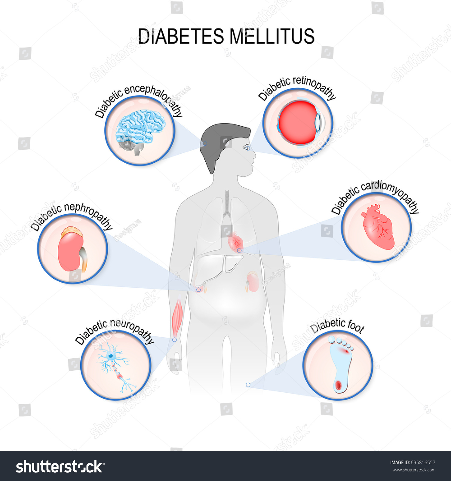 Complications Diabetes Mellitus Nephropathy Diabetic Foot Stock ...