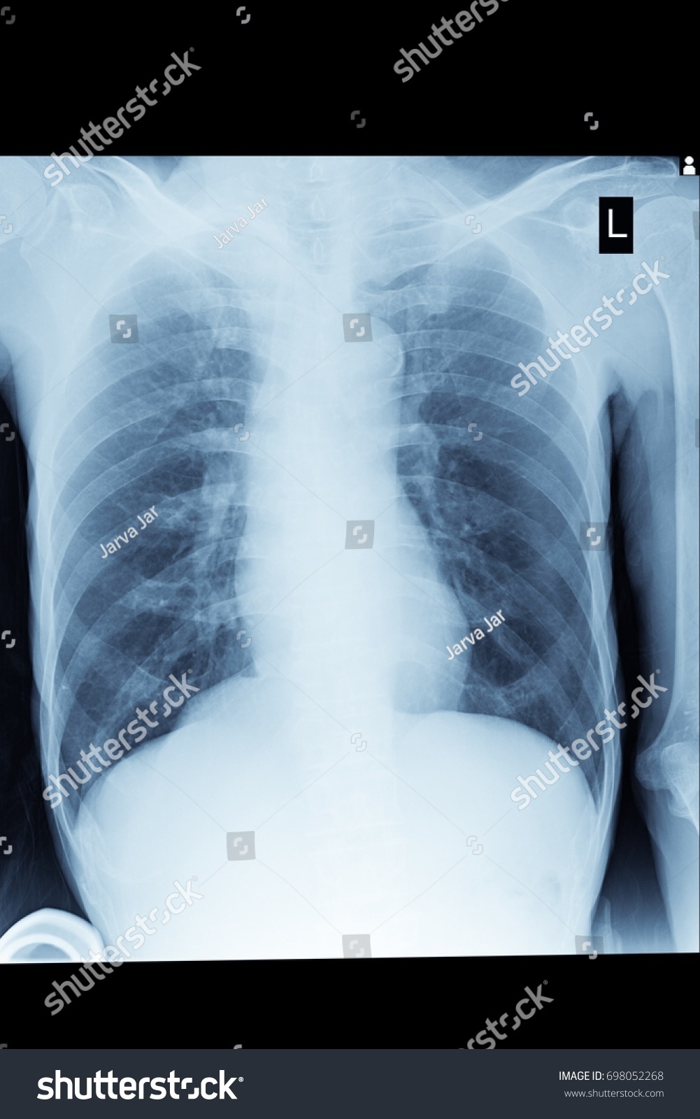 Chest Xray Stock Photo 698052268 | Shutterstock