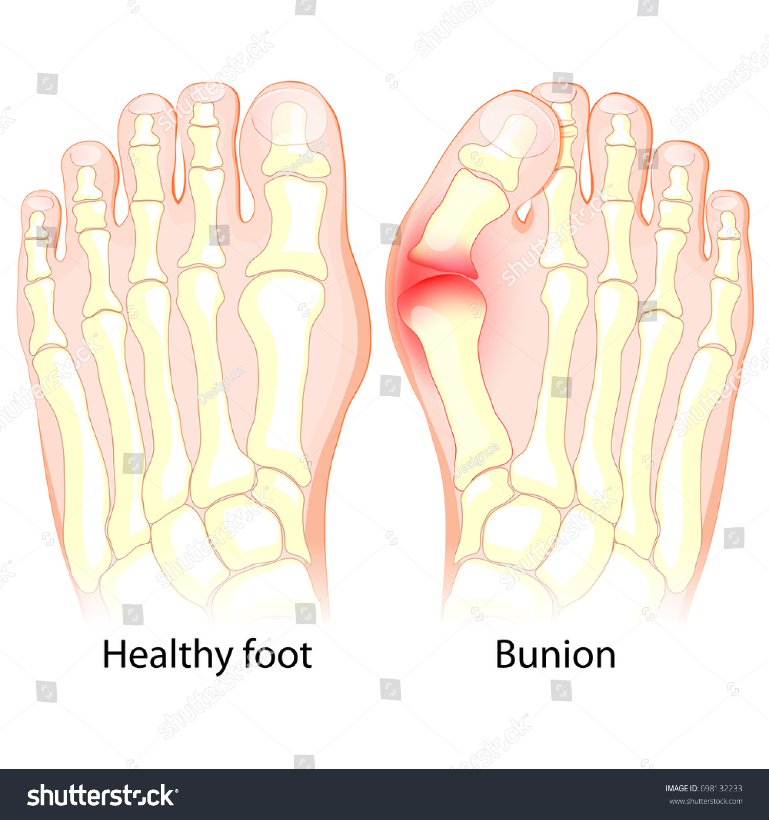 Healthy Foot Foot Bunion Human Anatomy Stock Vector (Royalty Free ...