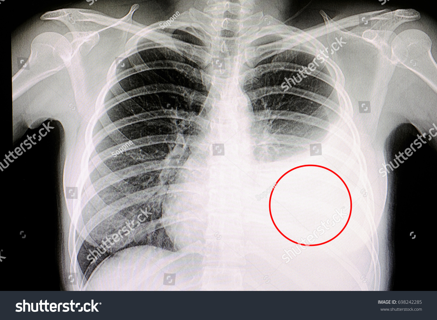 Chest Xray Film Patient Pulmonary Tuberculosis Stock Photo 698242285 ...