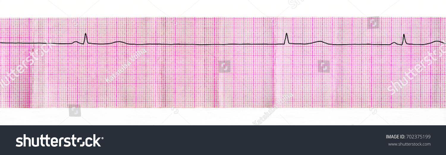 Ecg Tape Stop Sinus Node Sinus Stock Photo 702375199 | Shutterstock