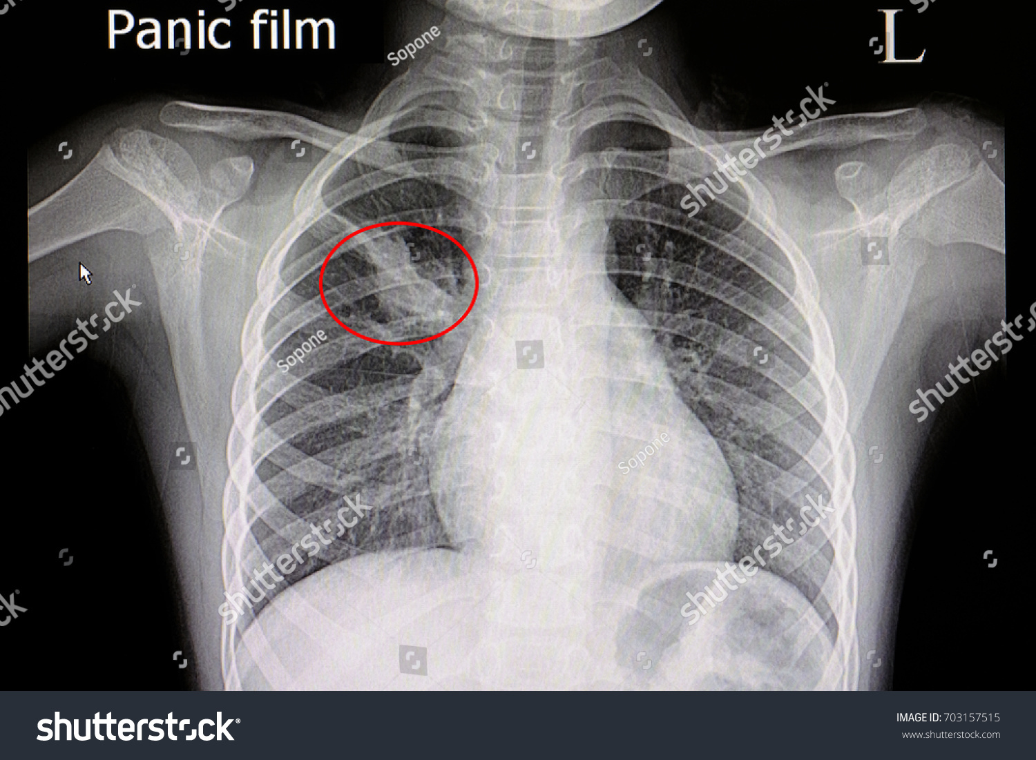 Xray Film Patient Pneumonia Atelectasis His ภาพสต็อก 703157515