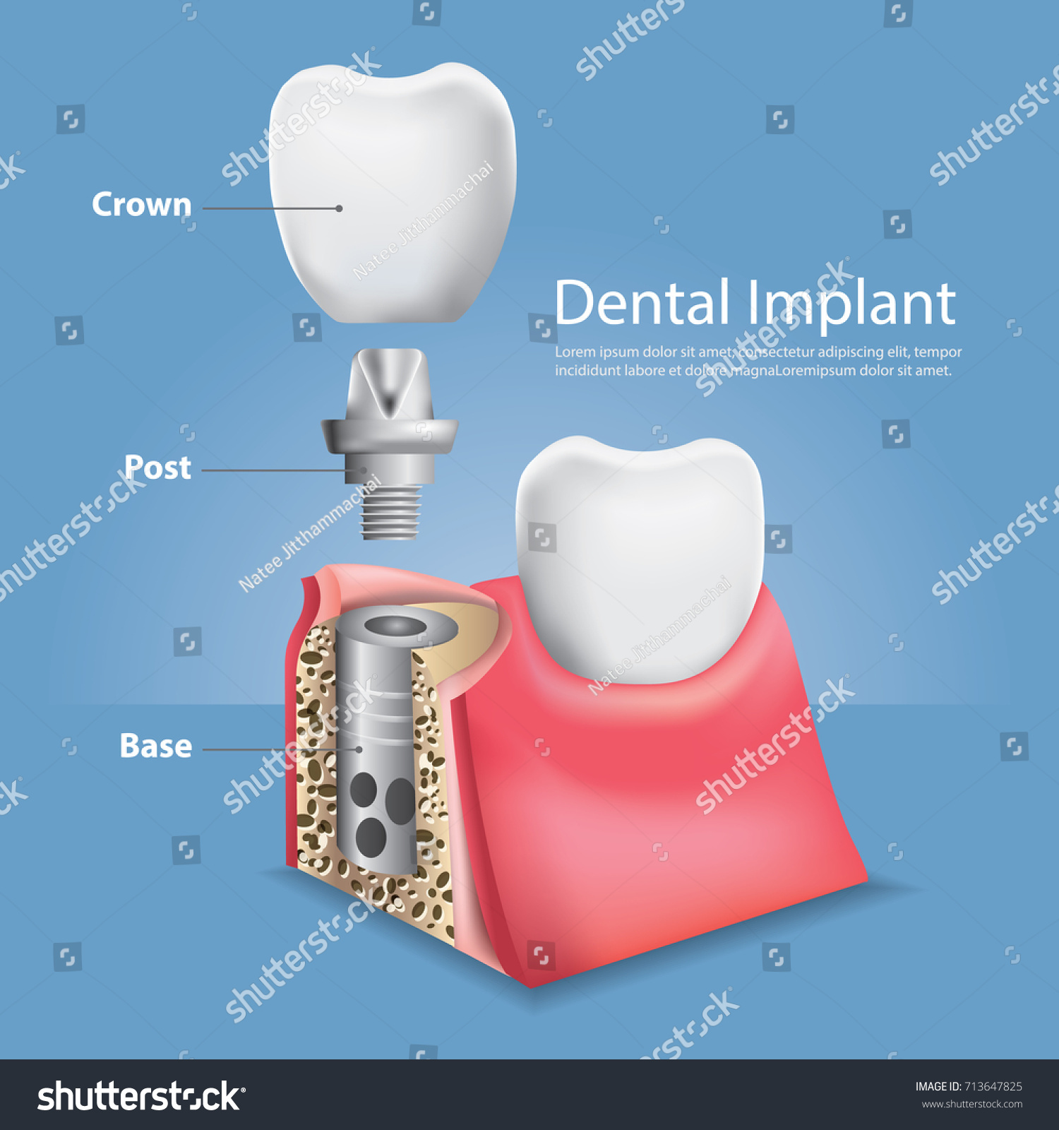 Human Teeth Dental Implant Vector Illustration Vector Có Sẵn Miễn Phí