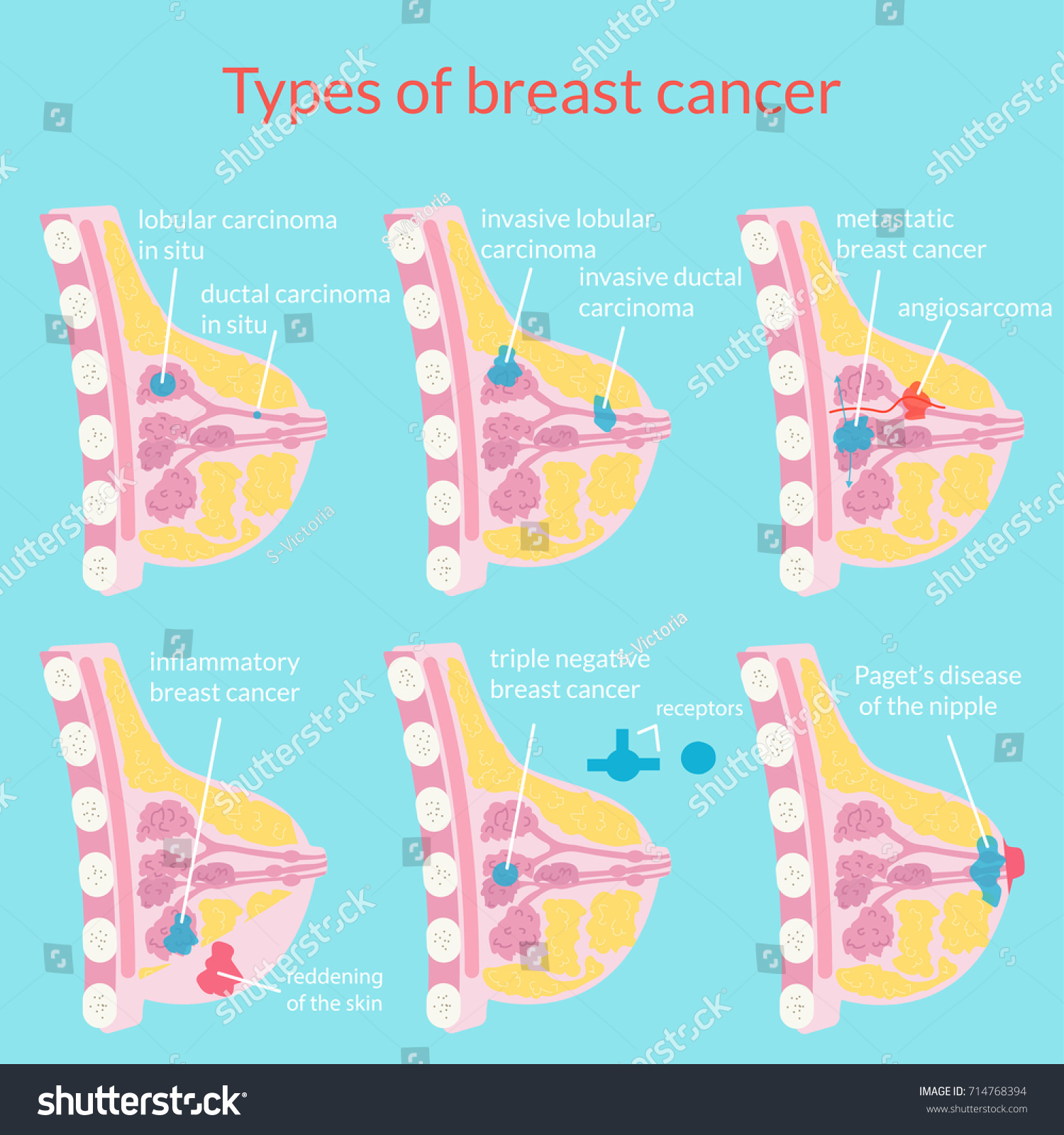 types-breast-cancer-medical-poster-vector-vetor-stock-livre-de