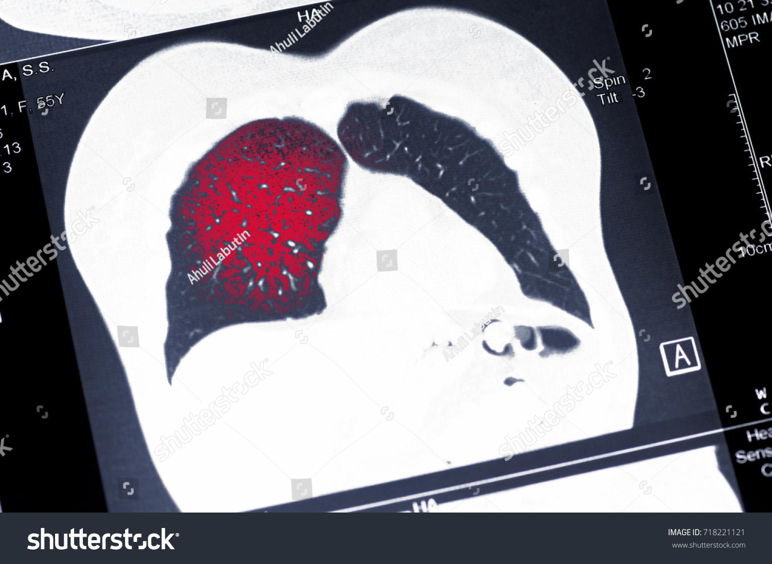 Tumor Lung Cancer Mri Highlighted Red Stock Photo 718221121 | Shutterstock