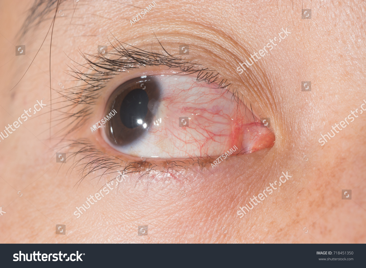 Close Pterygium During Eye Examination Stock Photo 718451350 | Shutterstock