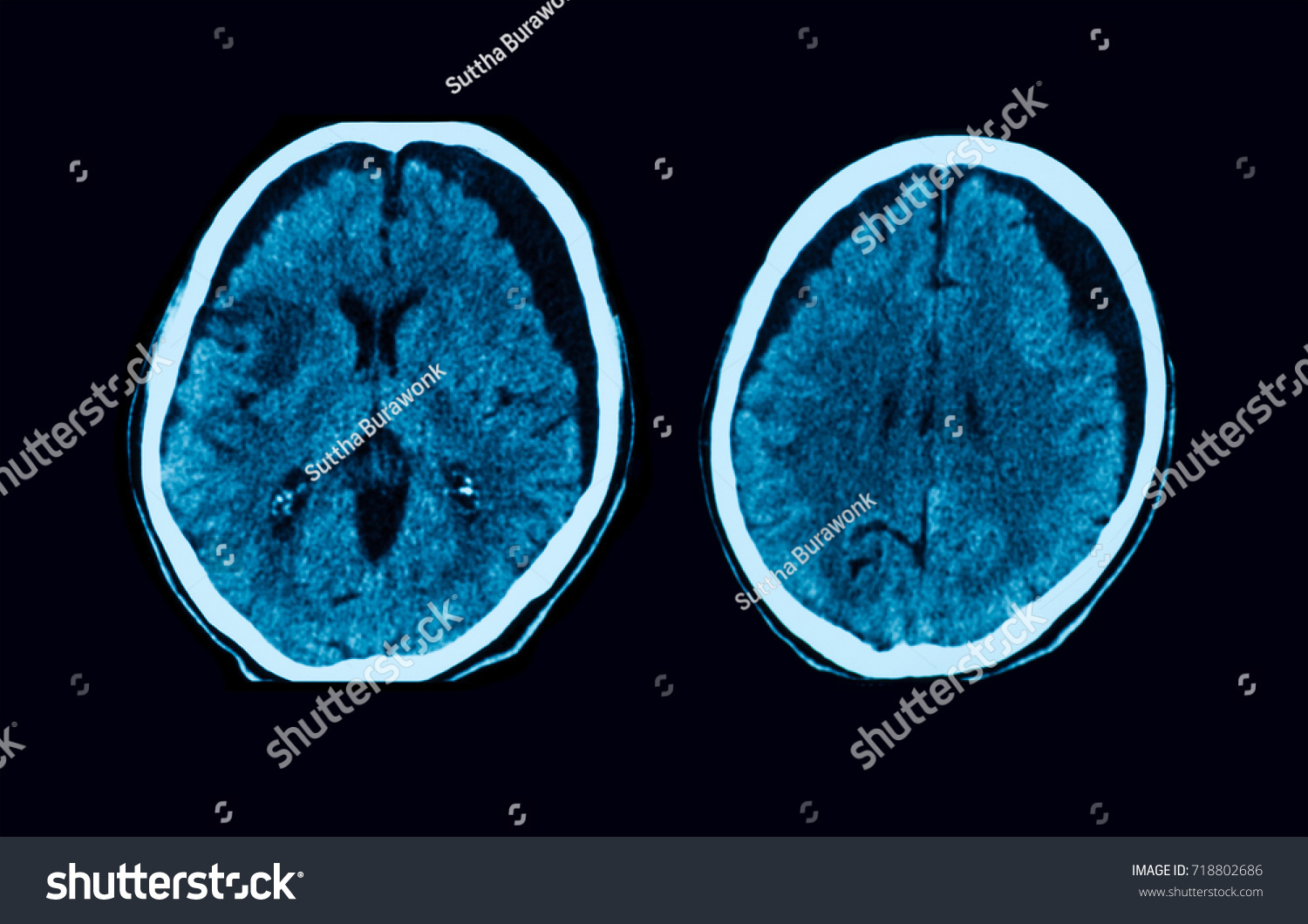 Computed Tomography Ct Scan Brain Showing Stock Photo 718802686 ...