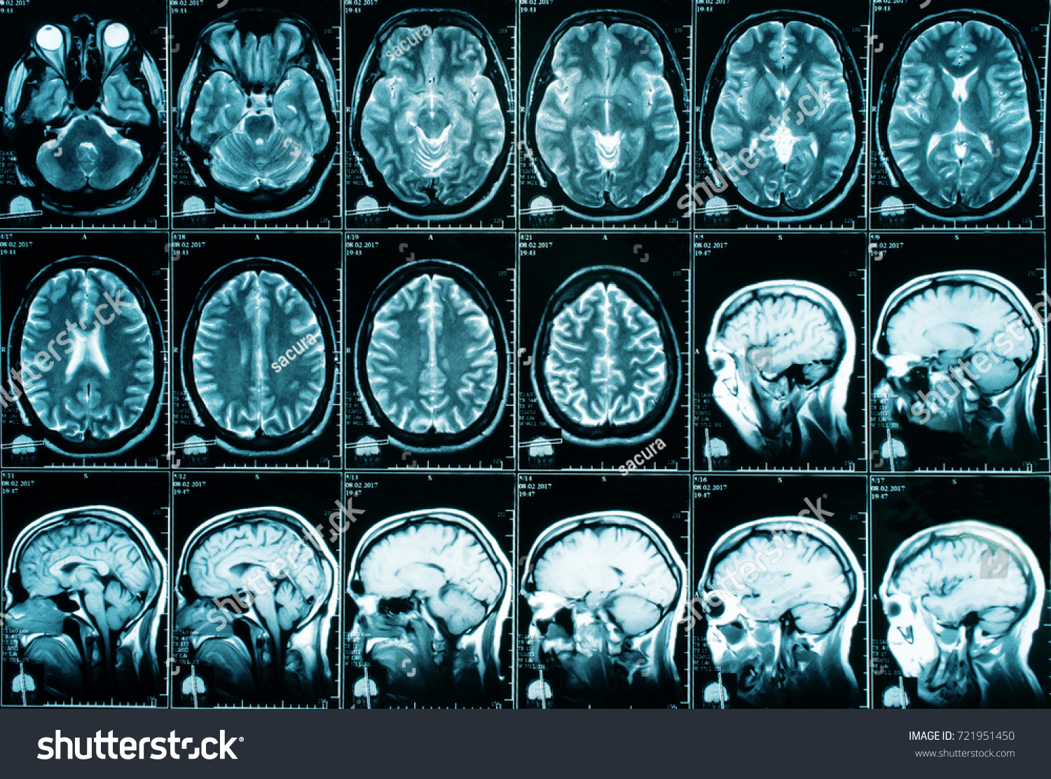 Томография головного мозга рентген