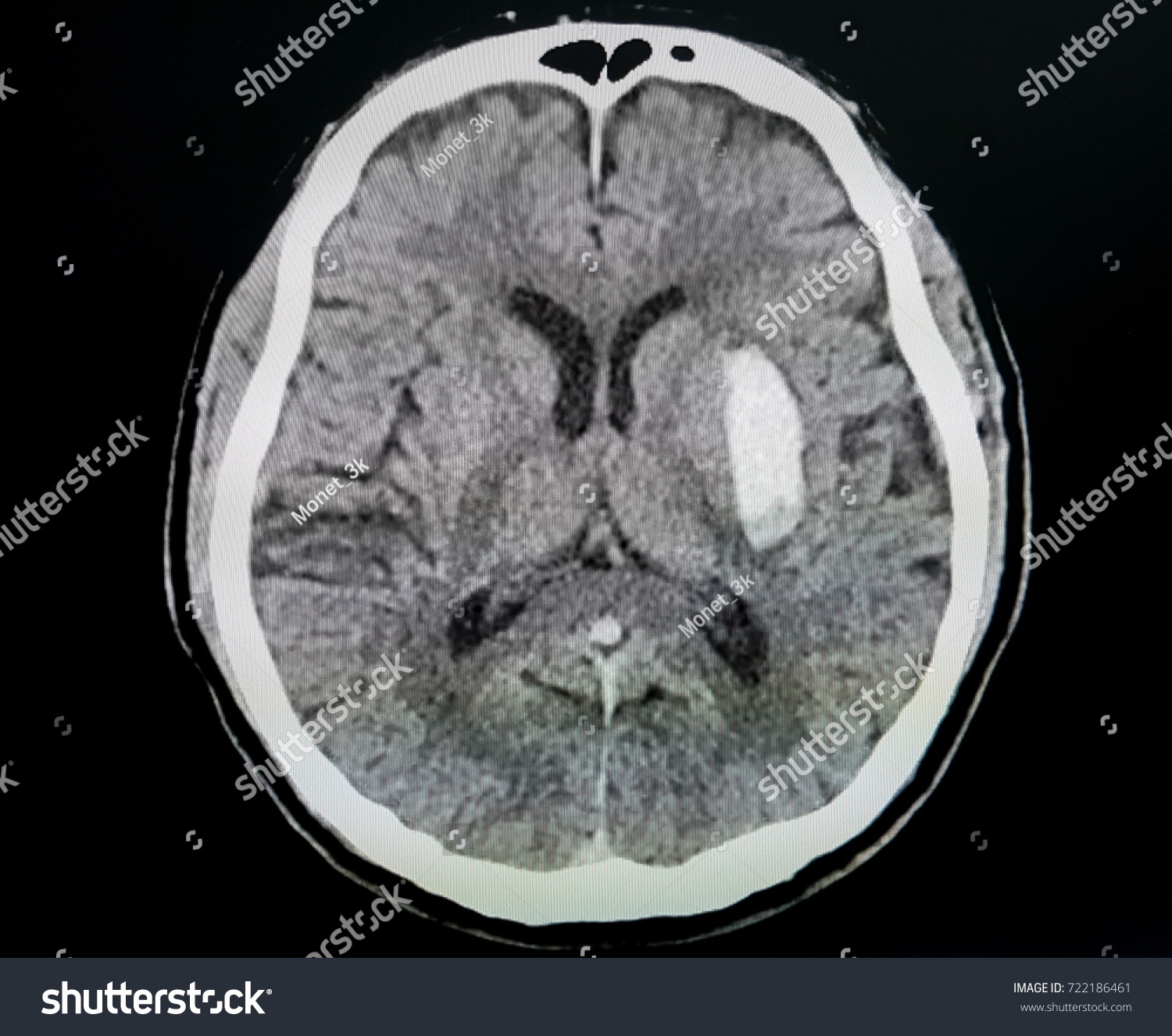 Ct Scan Brain Showing Intracerebral Haemorrhage Stock Photo Shutterstock