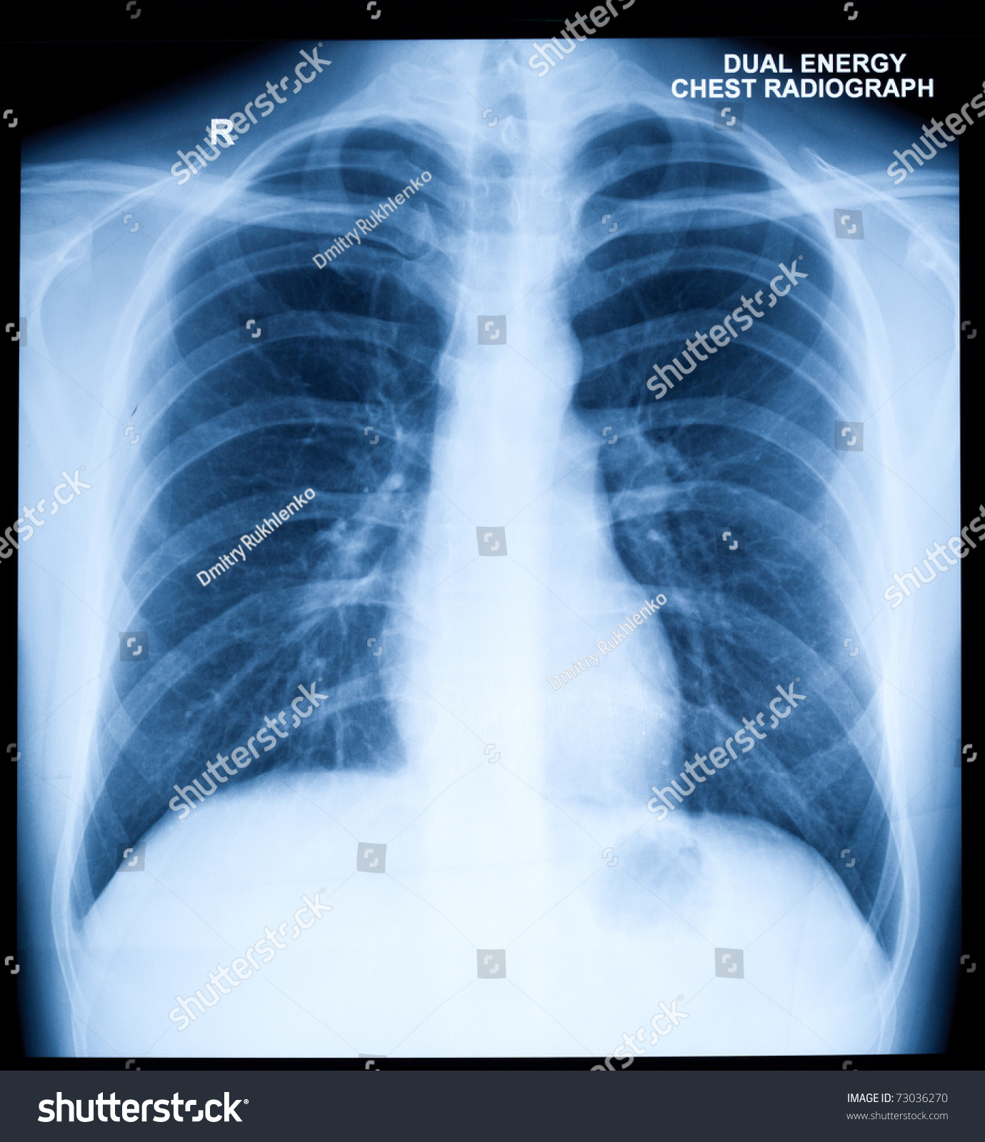 Xray Image Human Healthy Chest Stock Photo 73036270 | Shutterstock