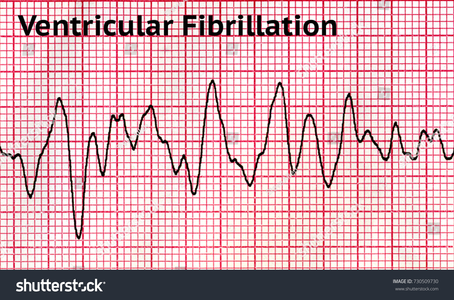 Стоковая фотография 730509730: Ventricular Fibrillation Vf Condition Which ...