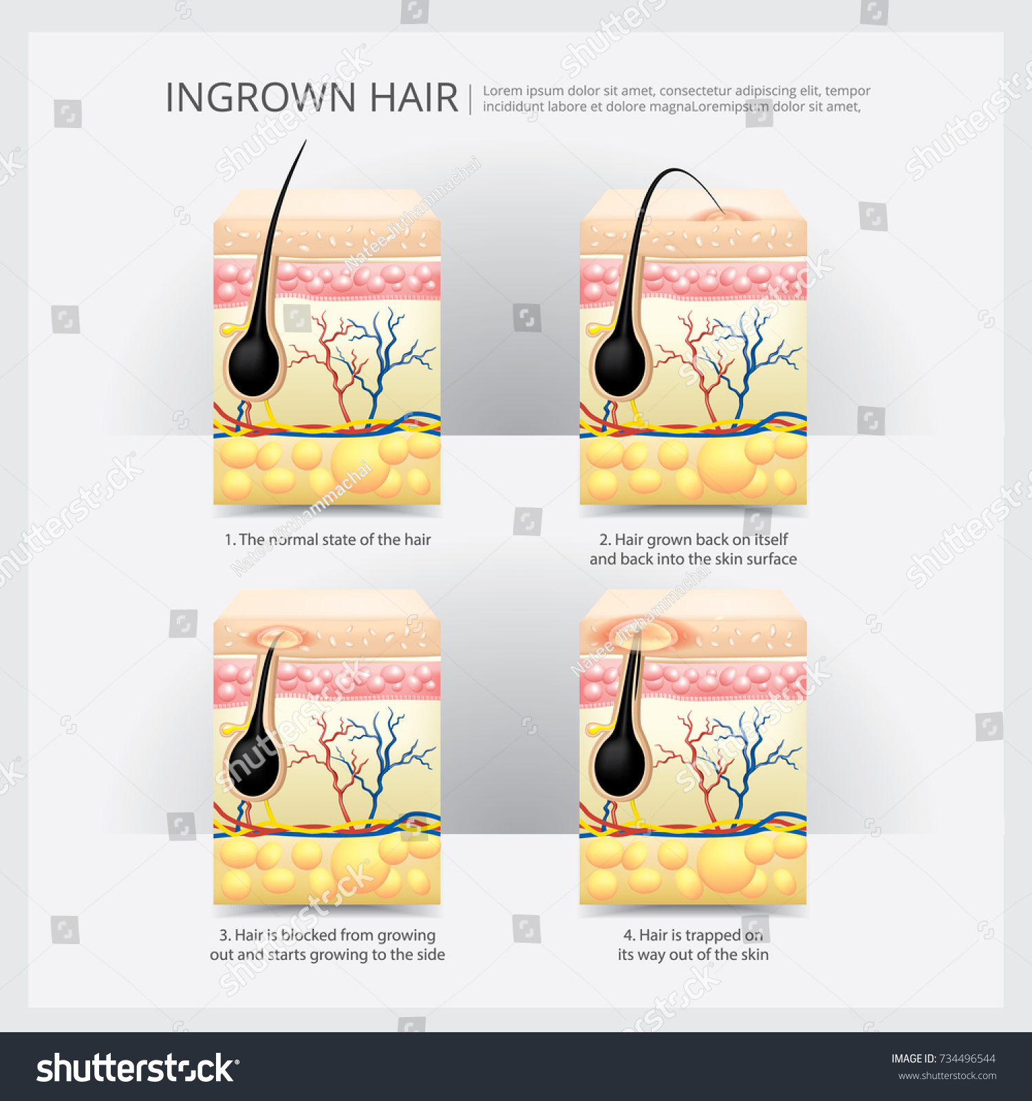 Ingrown Hair Structure Vector Illustration Stock Vector (Royalty Free ...