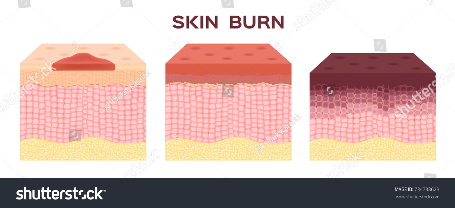 Step Burn Normal Serious Burn Skin Stock Vector (Royalty Free ...