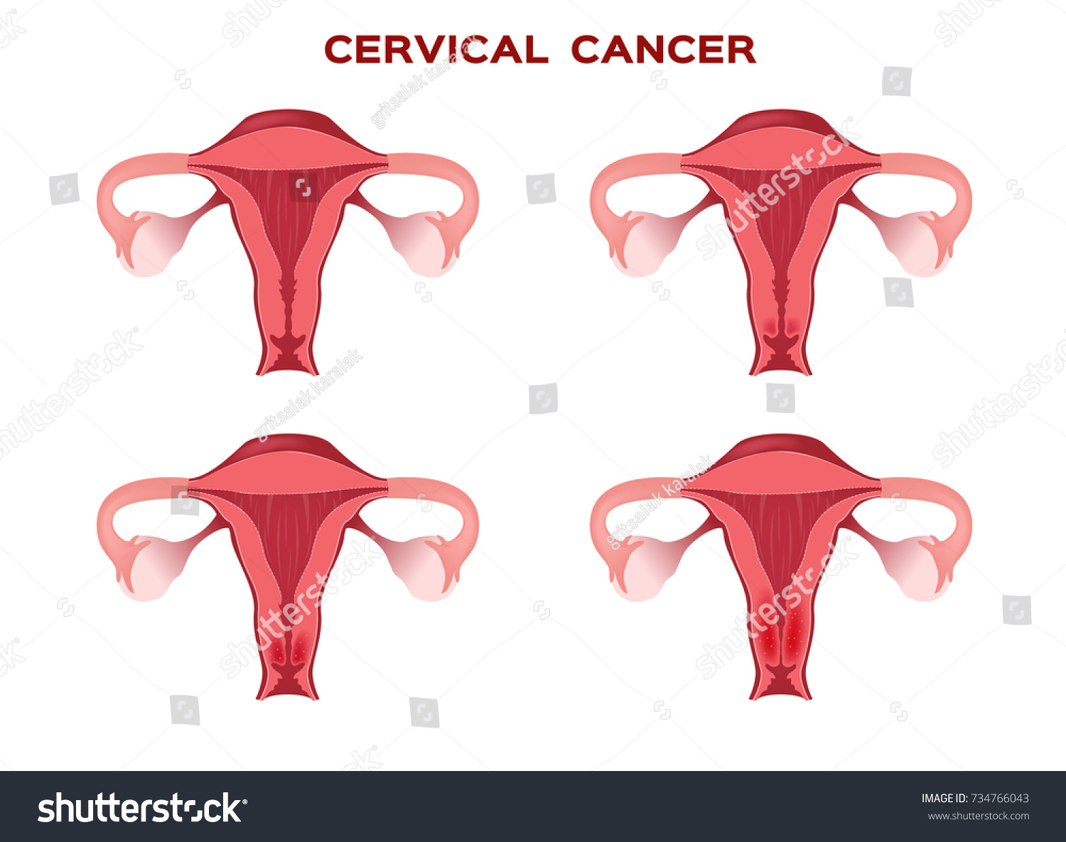 Cervical Cancer Women Uterus Anatomy Stock Vector (Royalty Free ...