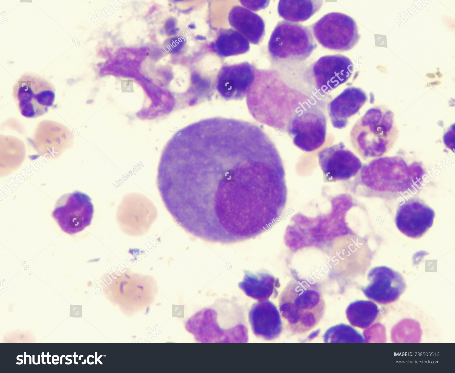 spindle cell tumors