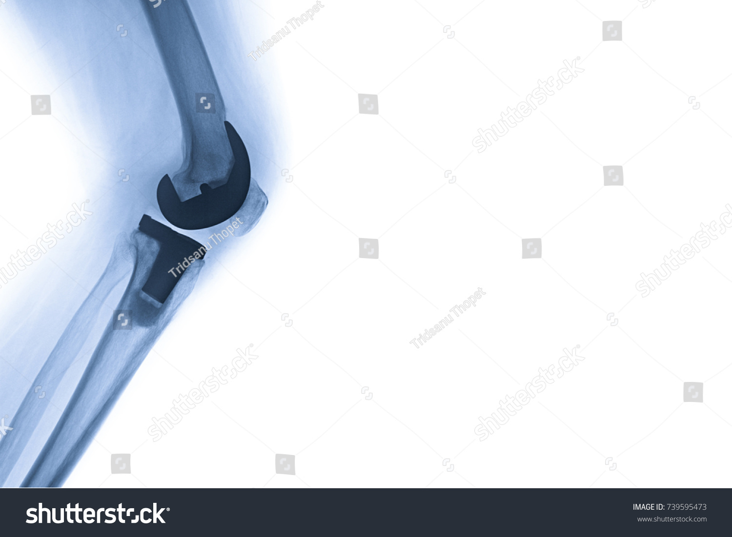 Xray Image Total Knee Arthroplasty Tka Stock Photo 739595473 | Shutterstock