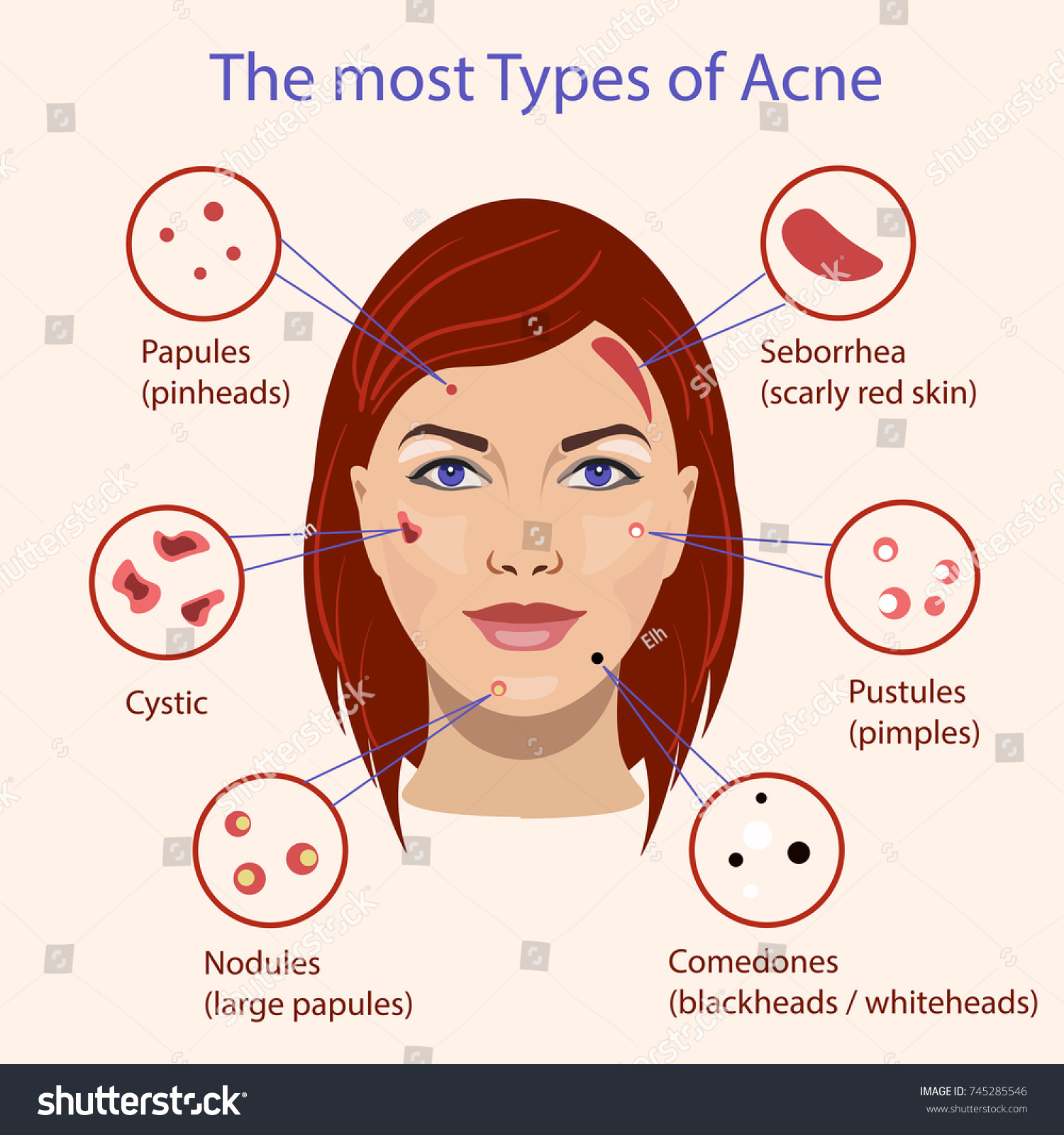 Different Type Acne Vector Illustration Skin Stock Vector (Royalty Free ...