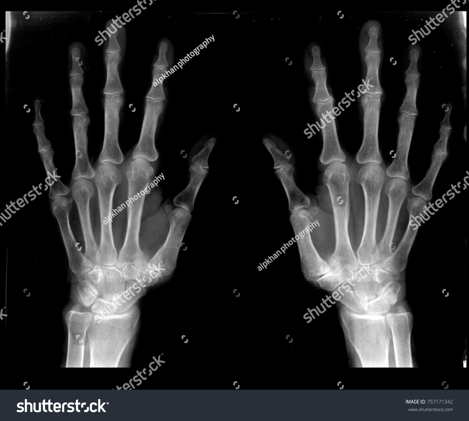 Xray Hands Stock Photo 757171342 | Shutterstock