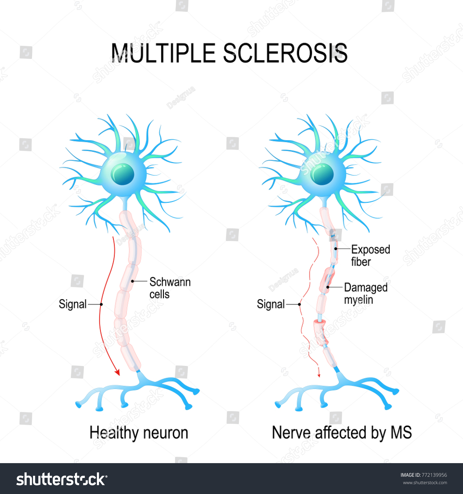 Multiple Sclerosis Ms Autoimmune Disease Nerves Stock Illustration ...