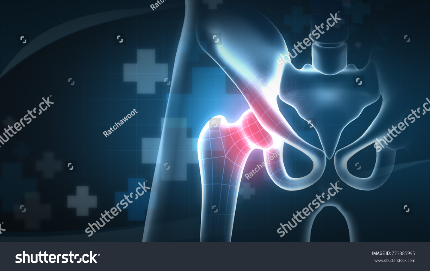 Hip Osteoarthritis Xray On Hitech Background Stock Illustration 773885995 Shutterstock