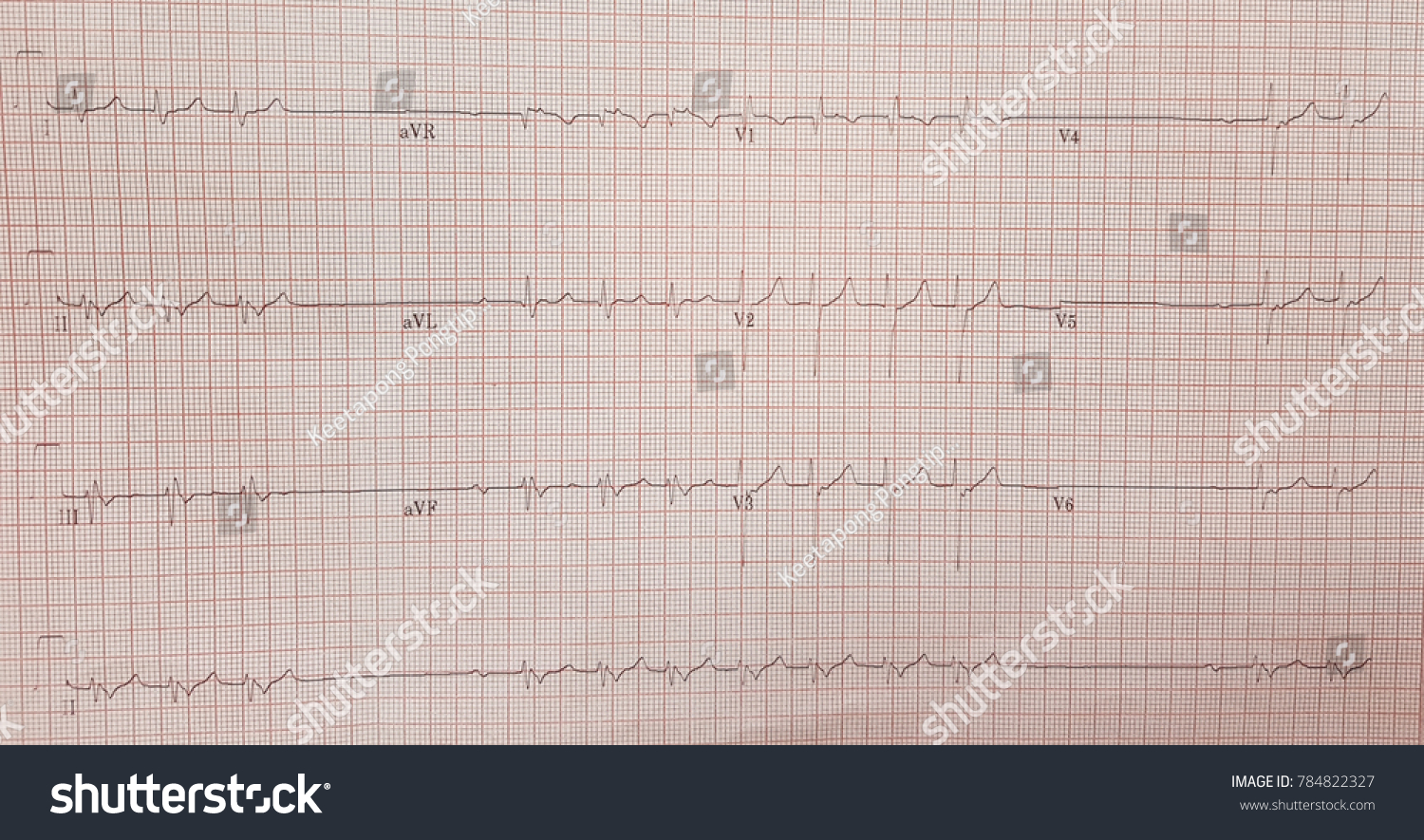 22 Retrograde P Wave Images, Stock Photos & Vectors | Shutterstock