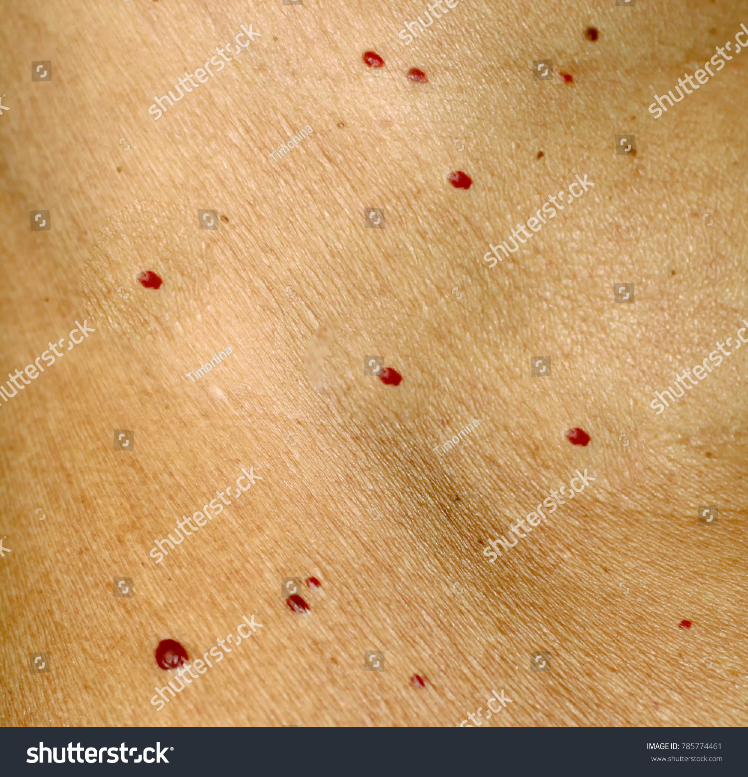 Angioma On Skin Red Moles On Stock Photo 785774461 | Shutterstock