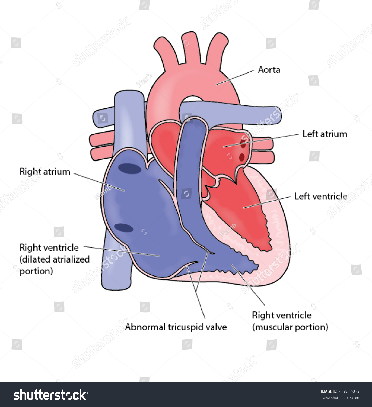 Heart Showing Ebsteins Anomaly Enlarged Right Stock Vector (Royalty ...