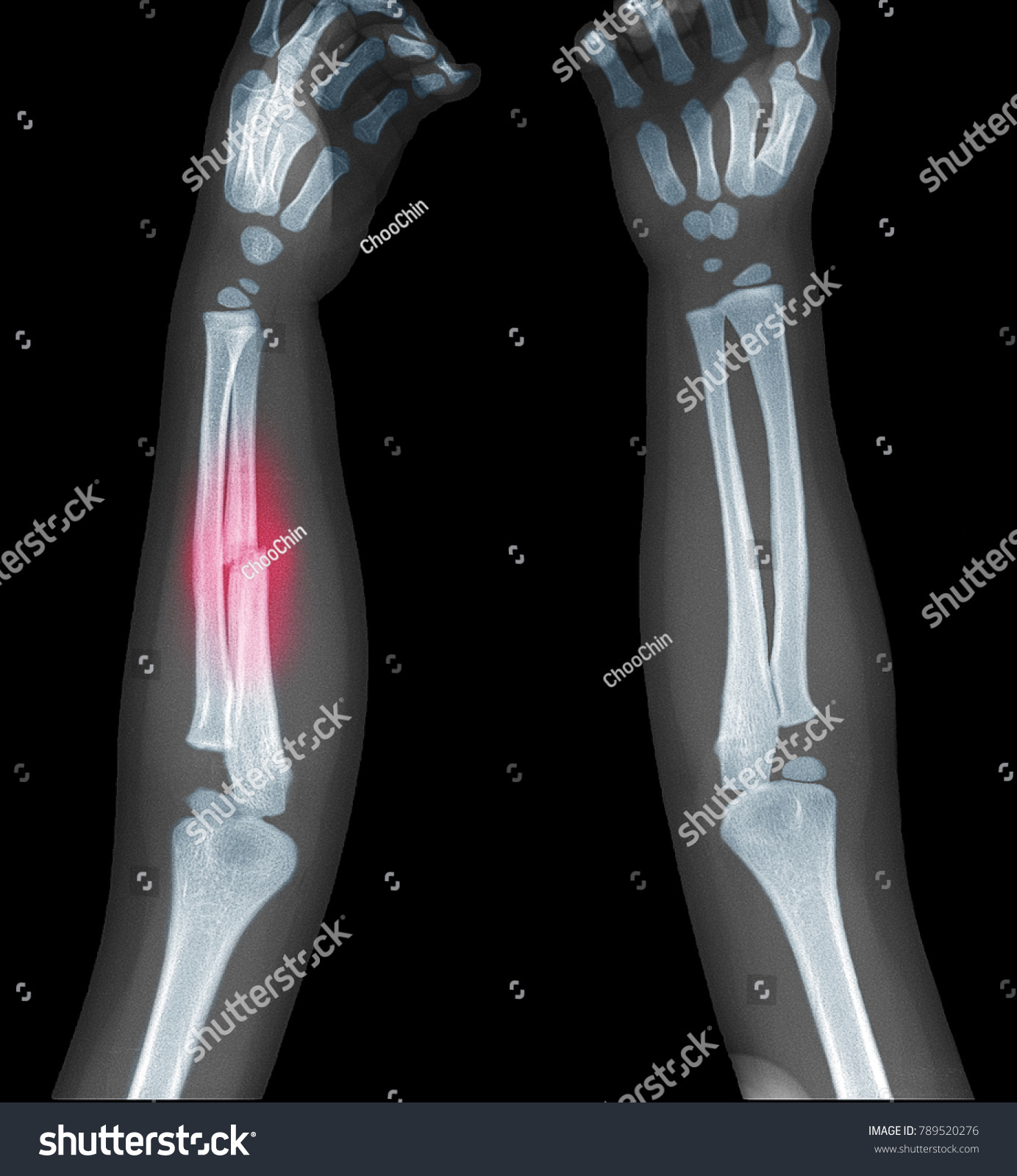 Xray Image Childs Forearm Show Bone Stock Photo 789520276 | Shutterstock