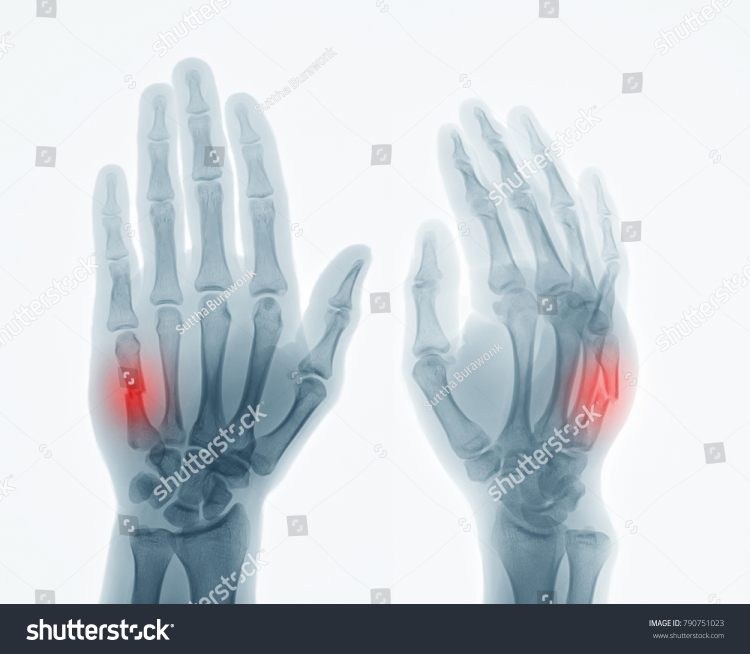 Anteroposteriorap Oblique Views Hand Xray Show Stock Photo 790751023 