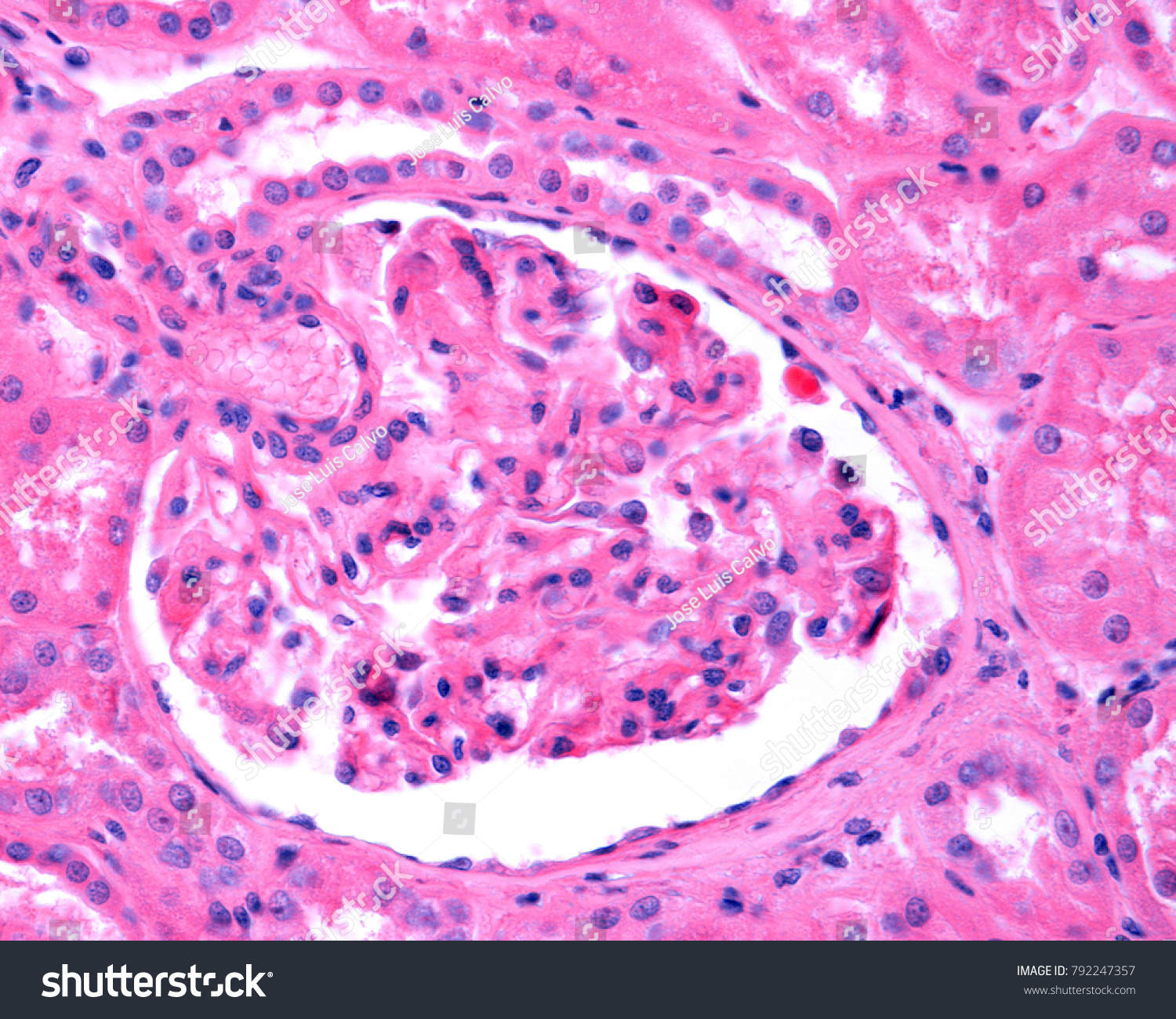 Kidney Glomerulus Affected By Membranous Glomerulonephritis Stock Photo ...