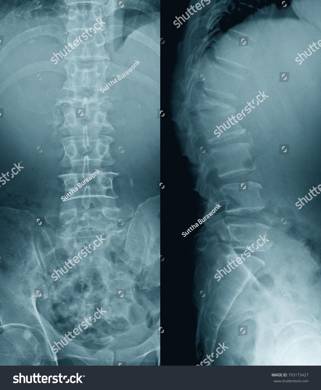 Computed Radiography Cr Lumbosacral Spine Ap Stock Photo 793173427 ...